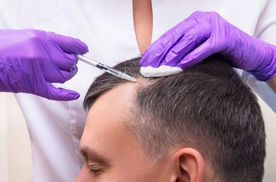 Hair Transplant Turkey – Restore Your Confidence Today