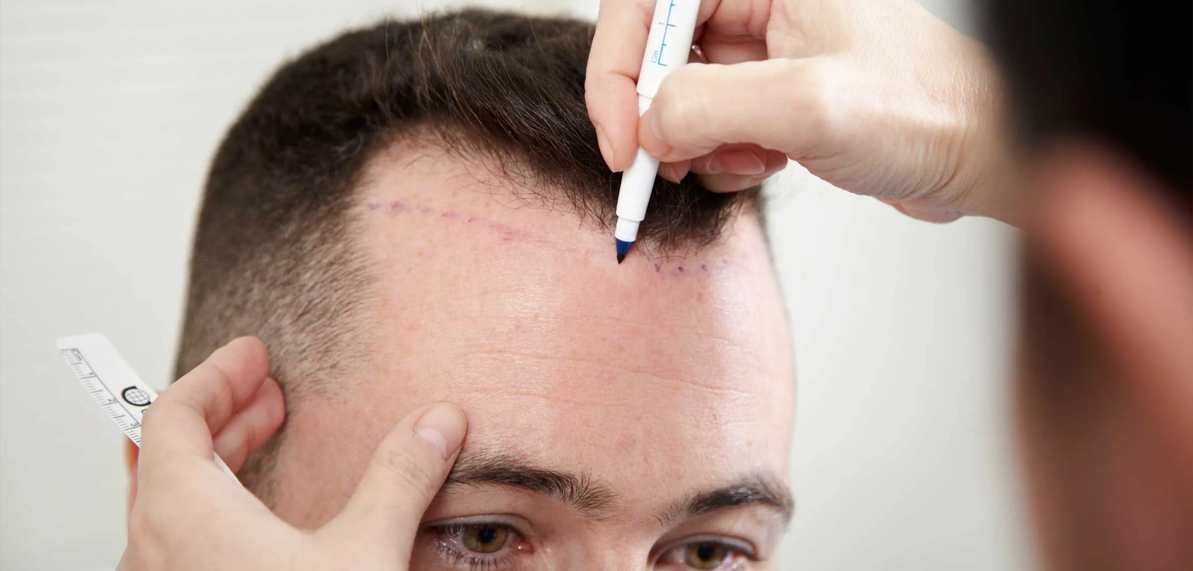 Hair Transplant London – Expert Hair Restoration at Westminster Medical Group®