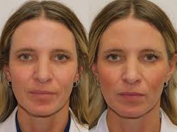 HarmonyCA Treatment for Collagen Stimulation