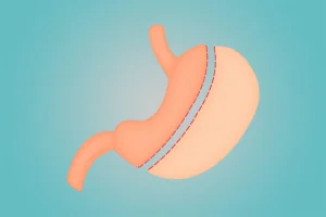 schlauchmagen-op-turkei